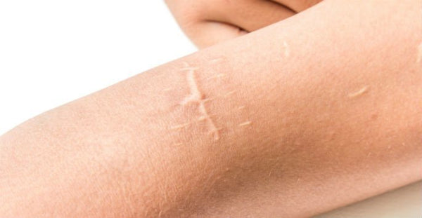 The Best Natural Pain Relief Cream for Natural Pain Relief After Surgery